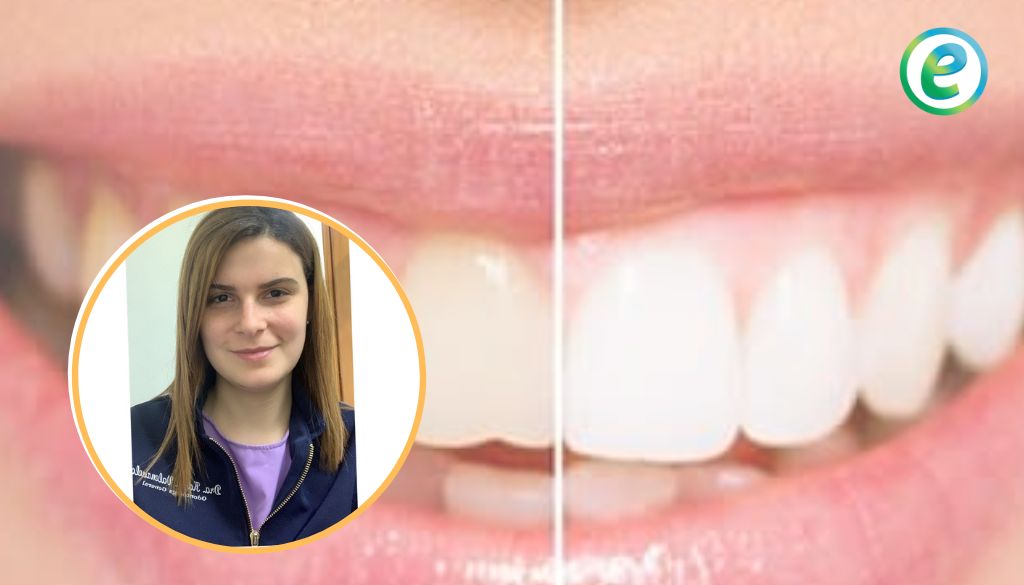 El blanqueamiento dental: mitos y realidades 